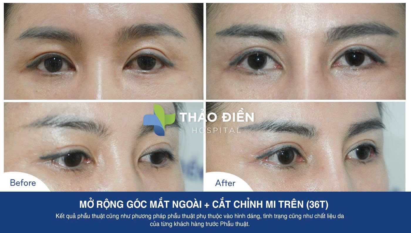 cat-mat-truoc-sau