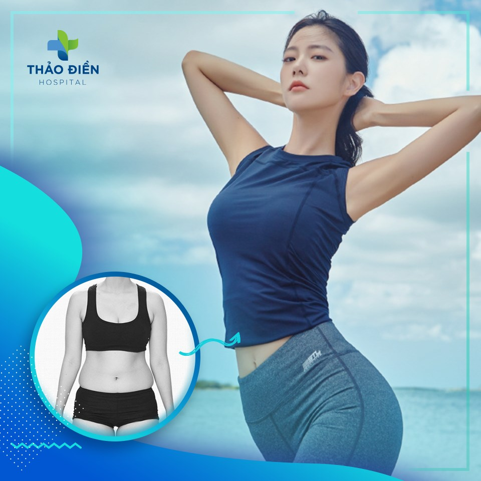 Hút mỡ bụng bao lâu thì lành? Cách chăm sóc để nhanh phục hồi