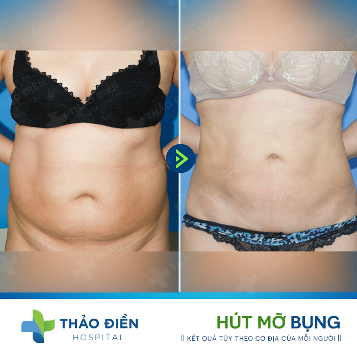 hut-mo-bungc-co-de-lai-seo-khong 3