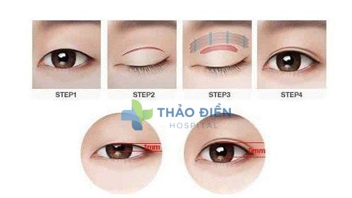 phuong-phap-cat-mi-mat