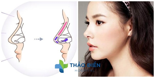 Nâng mũi bọc sụn